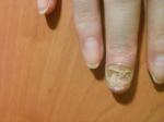 Восстановление ногтевой пластины фото 1