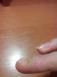 Восстановление ногтевой пластины фото 2