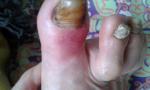Покраснение большого пальца ноги с периодическими болевыми схватками фото 1