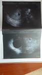 Фолликулярная киста и беременность фото 2