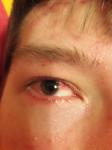 Красный глаз после удаления халязиона фото 1