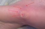 Воспаление и боли в ноге - после прижигания жидким азотом фото 1