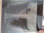 Рентгенография грудной клетки фото 1