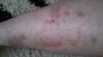 Лечение кожных заболеваний на ногах фото 2