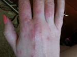 Аллергический контактный дерматит фото 1