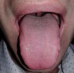 Одностороннее жжение языка. (фото) фото 2