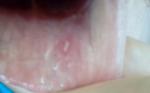 Белоеипятно на внутренней стороне губы фото 1