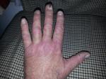 Холодовая аллергия на ладонях рук, растрескивание кожи и зуд фото 2