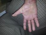 Холодовая аллергия на ладонях рук, растрескивание кожи и зуд фото 3