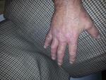 Холодовая аллергия на ладонях рук, растрескивание кожи и зуд фото 4
