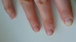 Повреждение ногтевой пластины на руках фото 1