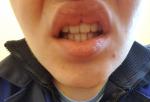 Косметический деффект верхней губы фото 1