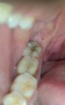 Пятна на слизистой рта, заболевание крови фото 1