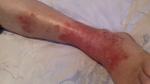 Повреждение кожи на ноге фото 1