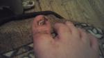 Онемение пальца после удаления ногтя фото 1