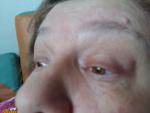 Припухлость во внешних уголках глаз безболезненно увеличивается вертикально 12 дней фото 1