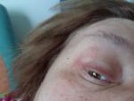 Припухлость во внешних уголках глаз безболезненно увеличивается вертикально 12 дней фото 3