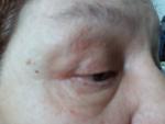 Припухлость во внешних уголках глаз безболезненно увеличивается вертикально 12 дней фото 4