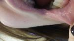 Проблема со слизистой губ и языка фото 1