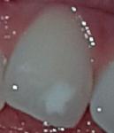 Белое пятно на зубе фото 1