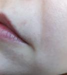 Пузырьковая сыпь вокруг рта фото 2