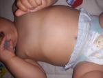 Легкая рахитная деформация грудной клетки у ребёнка фото 1