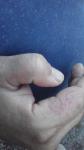 Шелушение и покраснение на пальцах рук фото 2