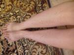 Сыпь на ногах ярко выражена фото 2