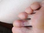 Травма пальца ноги фото 1
