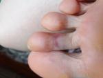 Травма пальца ноги фото 2