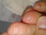Подозрительная кожа на ногтях и пальцах фото 4