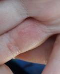 Обсыпания на пальцах у ребенка фото 2