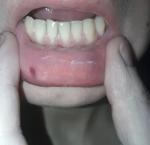 Проблемы слизистой рта, белые полосы на щеках и губах фото 1