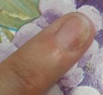 Дистрофия ногтей или псориаз фото 1