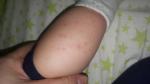 Сыпь у ребенка, без температуры, не однородная фото 1
