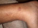 Зудящие раны на ноге фото 2