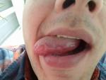 Воспаление сосчков на кончике языка фото 2
