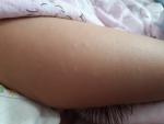 Сыпь у ребенка на ладошках руках и выше колена фото 2