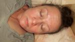Аереодическое высыпание на лице в основном на лбу фото 1