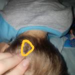 Шишка на голове к ребенка в 3 года фото 1