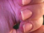 Трещины, под ногтями белые утолщения виде засохшей кожи фото 4