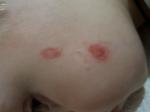 Красное пятно на лице у ребенка фото 1