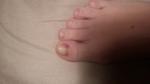 Проблемы с ногтями после тесной обуви фото 2