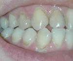 Зубной налёт или кариес? фото 1
