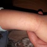 Пупырышки на руке у ребенка фото 1