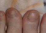 Светло-коричневое пятно на ногте пальца ноги фото 5