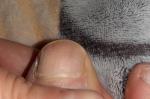Светло-коричневое пятно на ногте пальца ноги фото 4