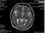 Головные боли, головокружения, МРТ головного мозга фото 2