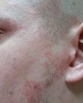 Воспаление кожи лица фото 2