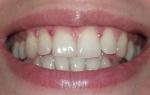 Углубления на эмали зубов и краснота десен фото 1